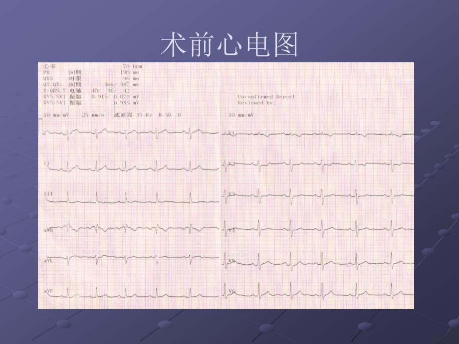 房缺封堵伞释放时致下壁导联ST段抬高6例_第4页