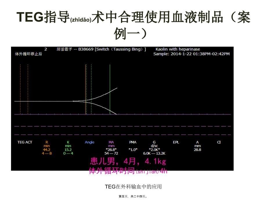 TEG在外科输血中的应用课件_第5页