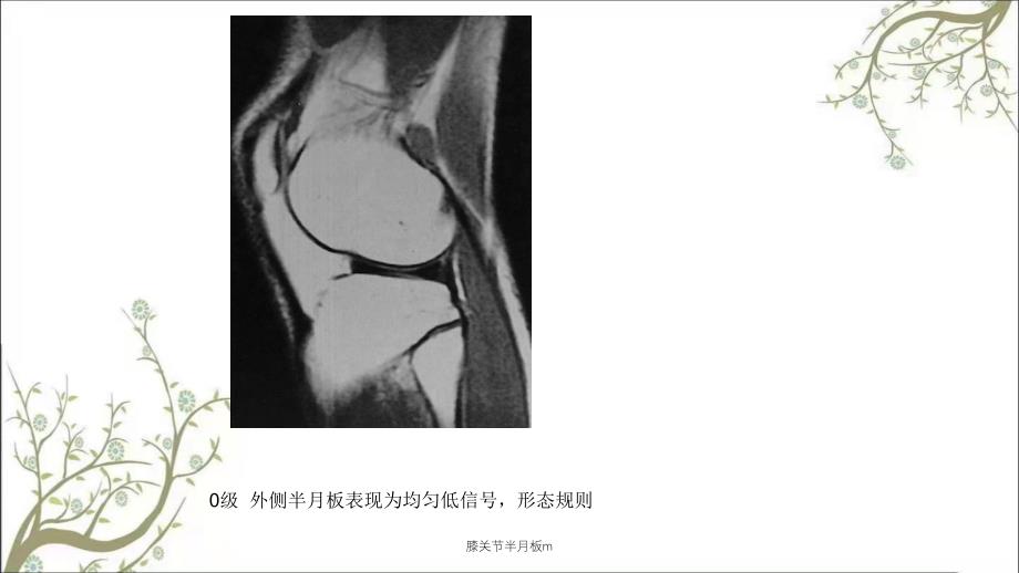 膝关节半月板m课件_第1页