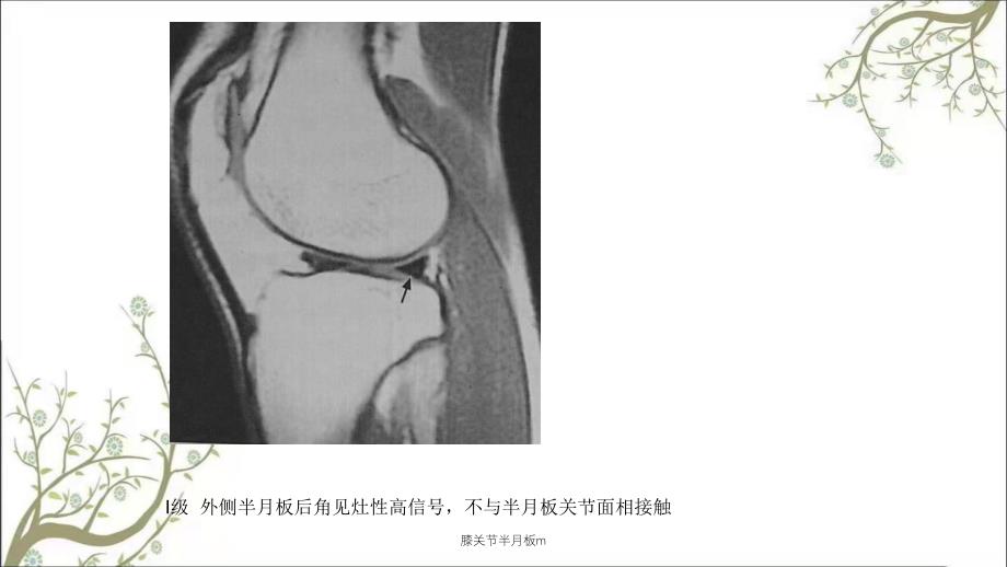 膝关节半月板m课件_第2页