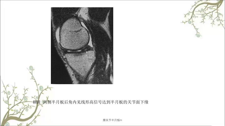 膝关节半月板m课件_第4页