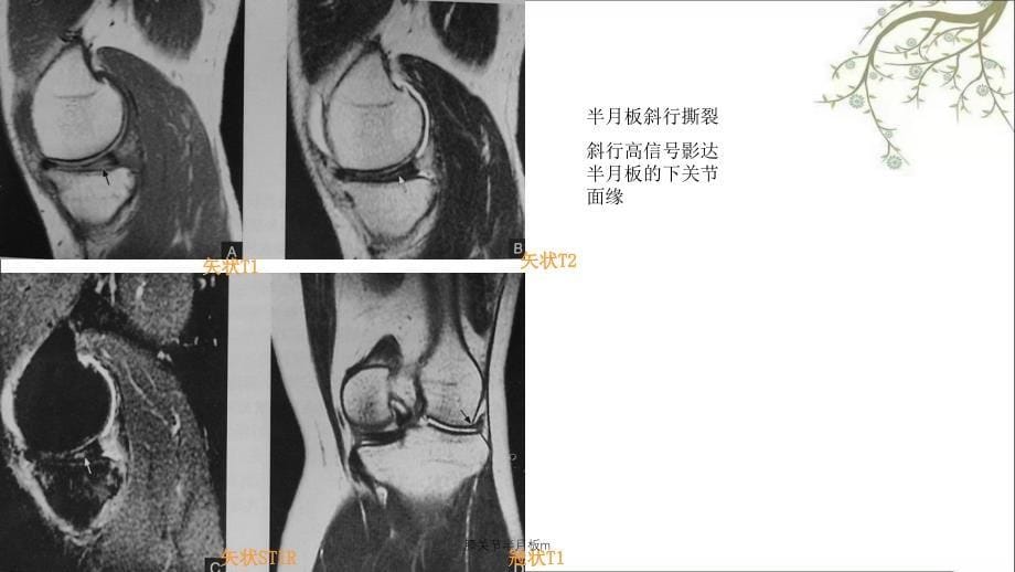 膝关节半月板m课件_第5页