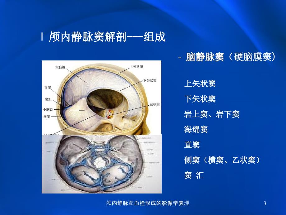 颅内静脉窦血栓形成的影像学表现课件_第3页