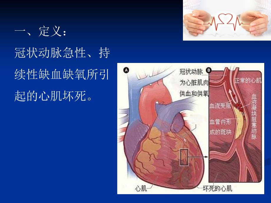 急性心梗抢救流程释解.ppt_第3页