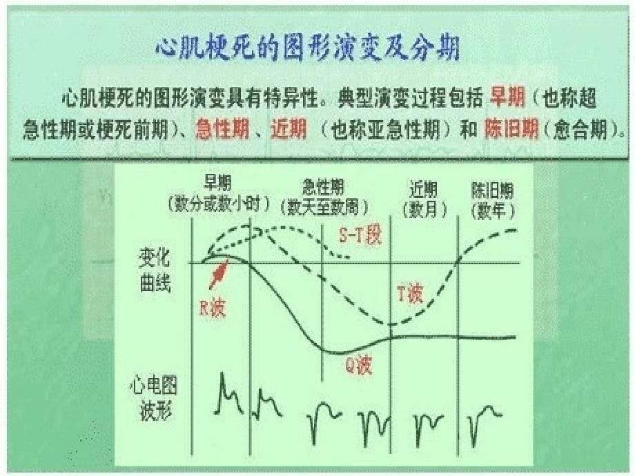 急性心梗抢救流程释解.ppt_第5页