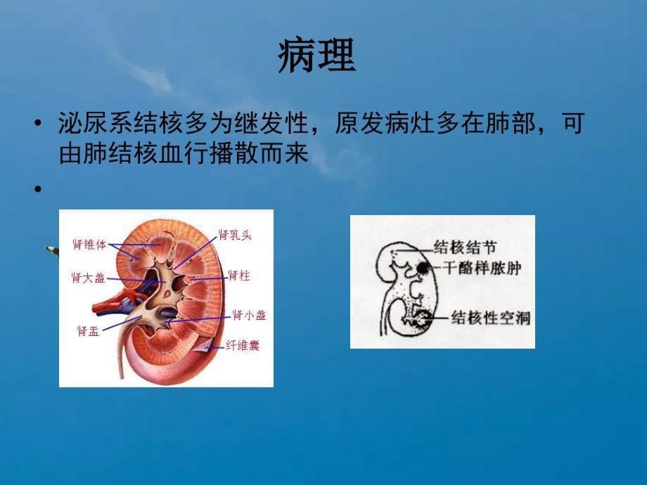 肾与输尿管结核ppt课件_第5页