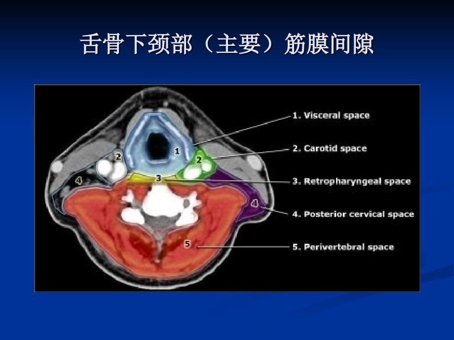 (舌骨下)颈部筋膜间隙——解剖与疾病诊断精讲(1).ppt_第5页