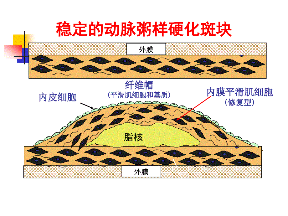 动脉硬化心脏病_第1页