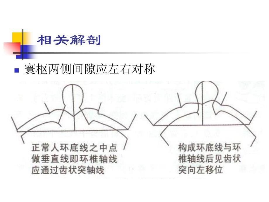 寰枢关节错型颈椎病文档资料_第5页