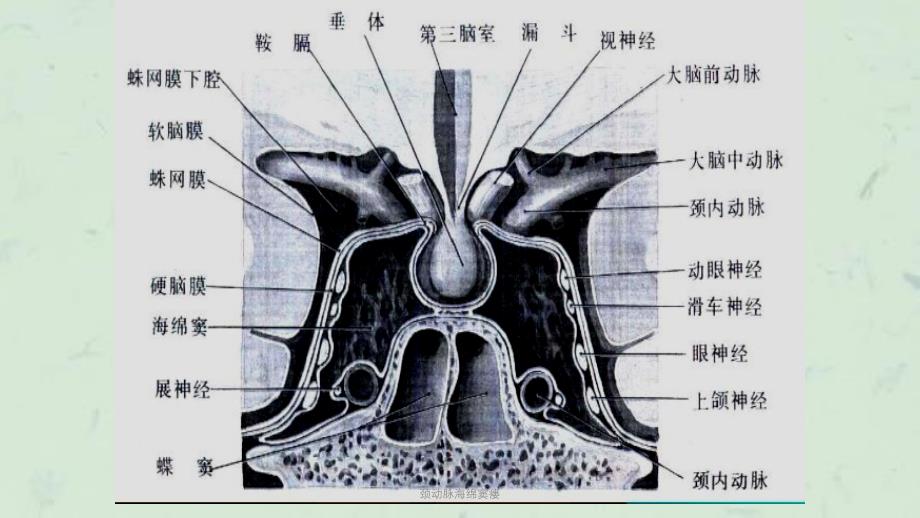 颈动脉海绵窦瘘课件_第4页