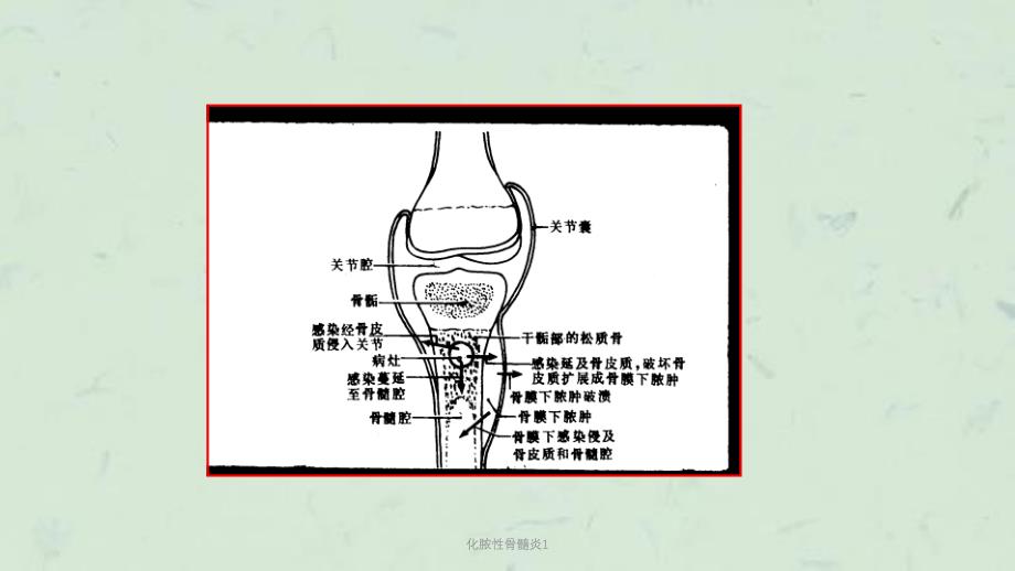 化脓性骨髓炎1课件_第3页