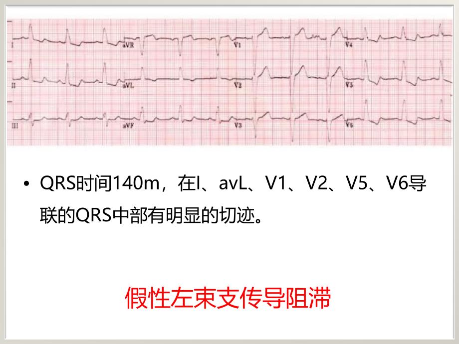 左束支传导阻滞与急性心肌梗死_第4页