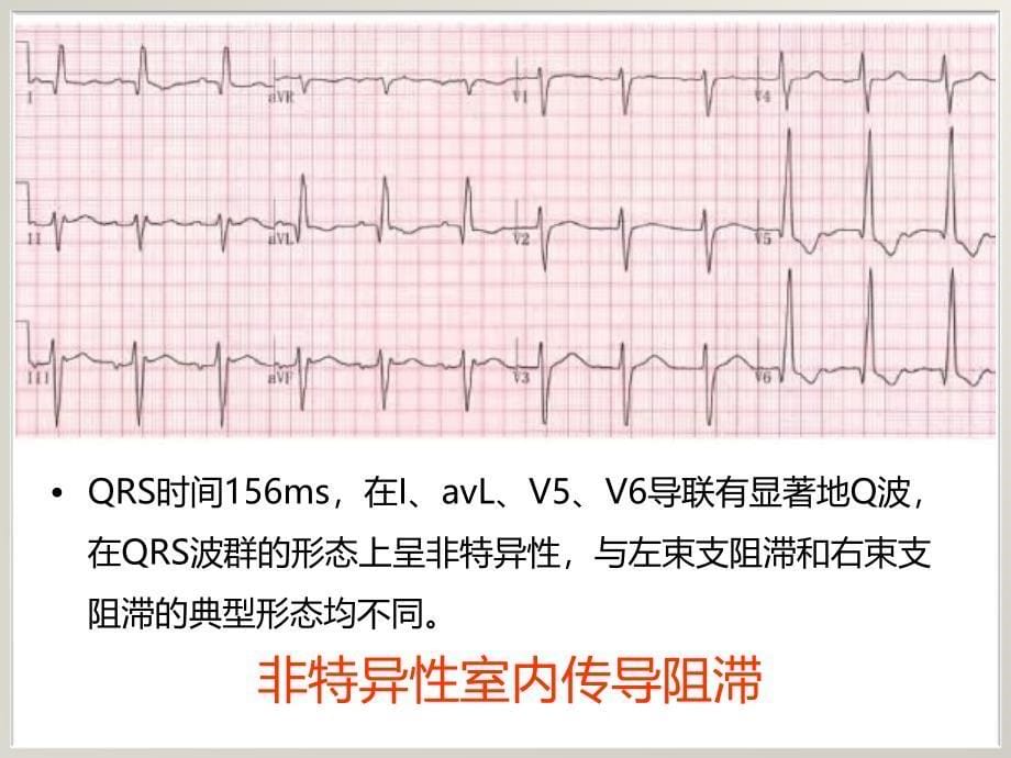 左束支传导阻滞与急性心肌梗死_第5页