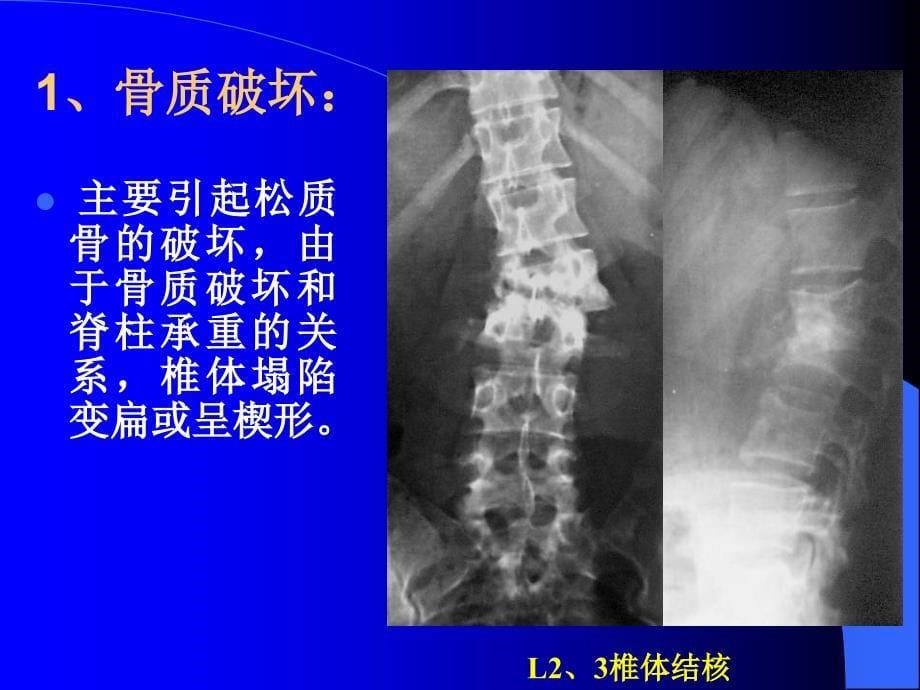 脊柱结核的影像学特点及手术时机的选择_第5页