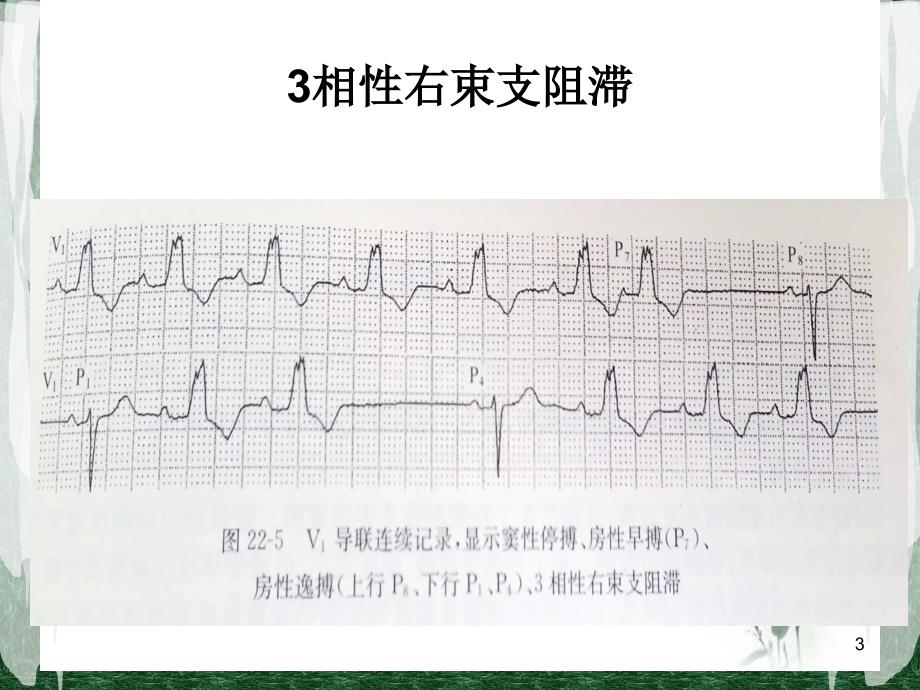 心电图频率依赖性束支传导阻滞培训ppt课件_第3页