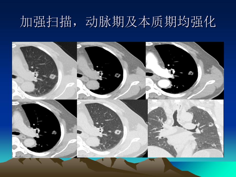 肺内单发空洞常见病变及其ct鉴别ppt课件_第3页