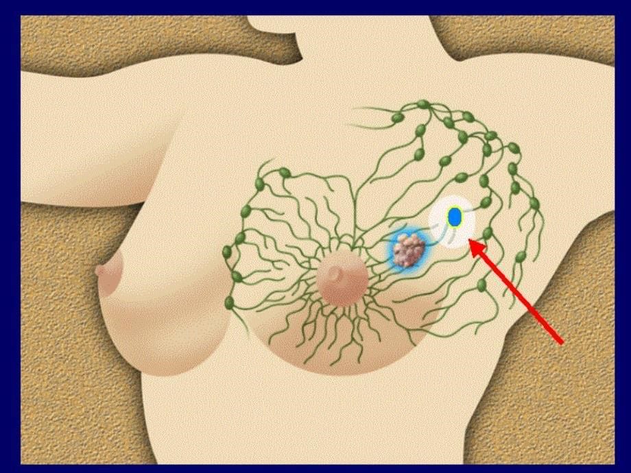 乳腺癌治疗介绍.ppt课件_第5页