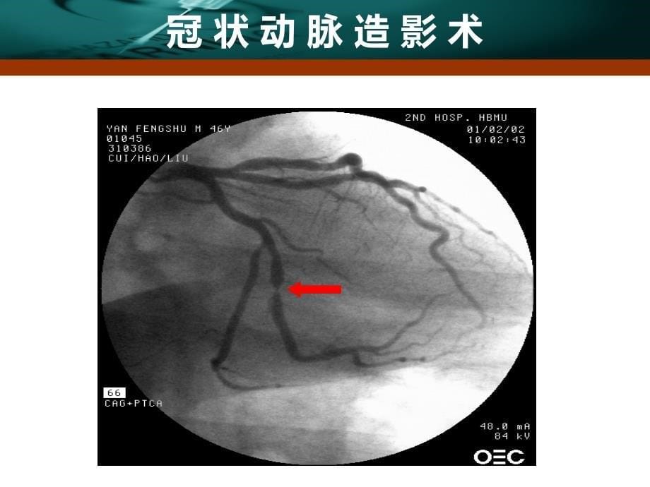 心内科介入治疗ppt课件_第5页