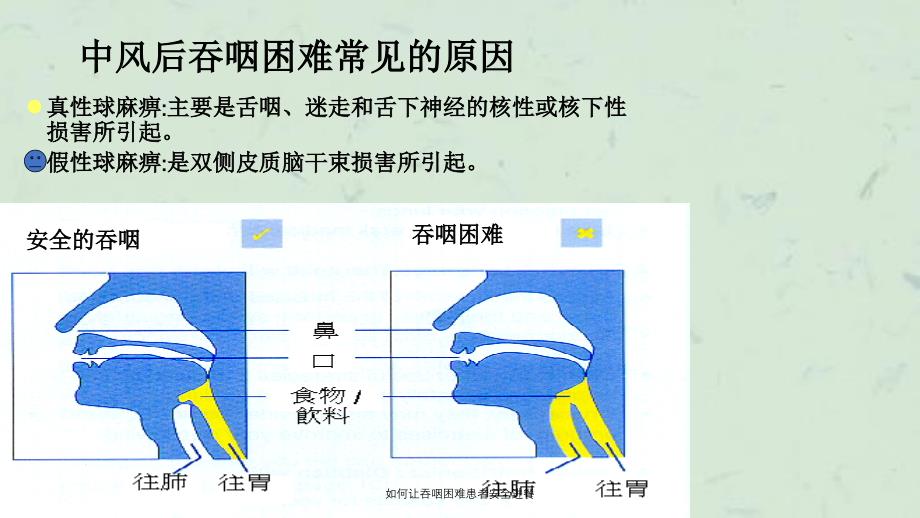 如何让吞咽困难患者安全进餐_第4页