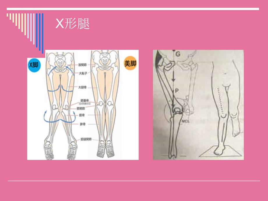 儿童发育过程常见下肢关节异常ppt课件_第4页