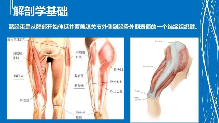 髂胫束综合征PPT参考幻灯片_第5页