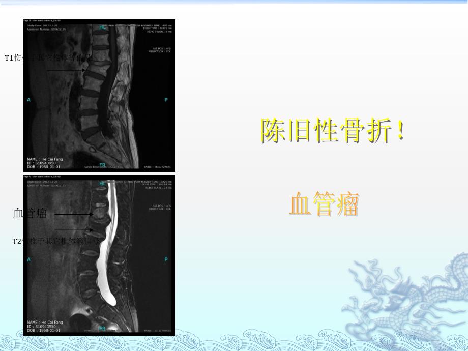 脊柱典型病例_第4页