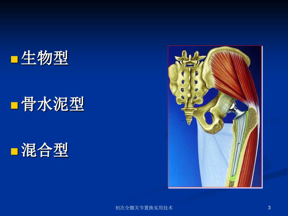 初次全髋关节置换实用技术课件_第3页