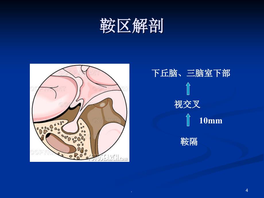 鞍区肿瘤ppt演示课件_第4页