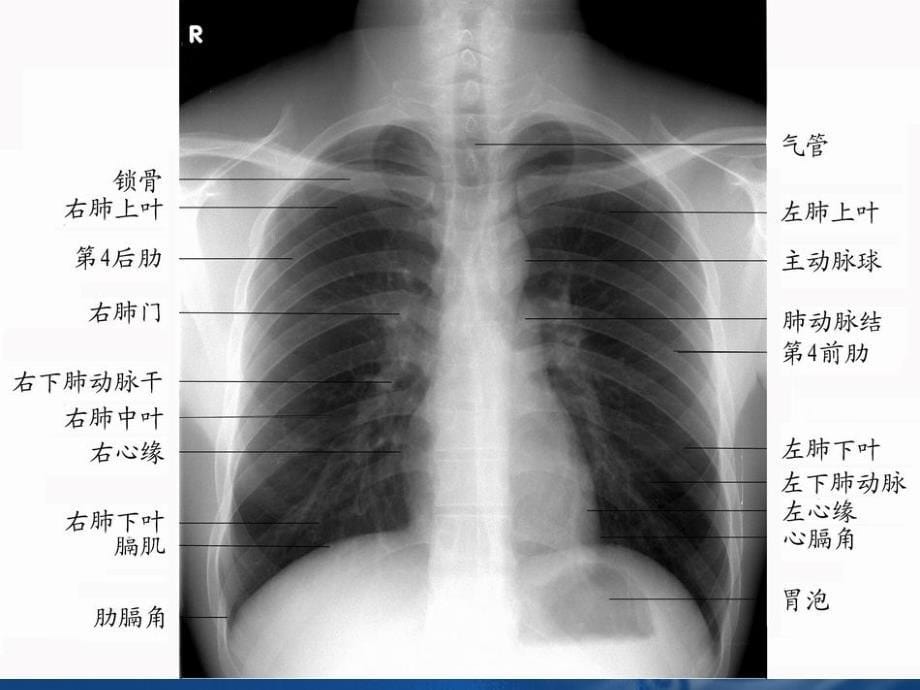 医学影像诊断学呼吸系统1_第5页