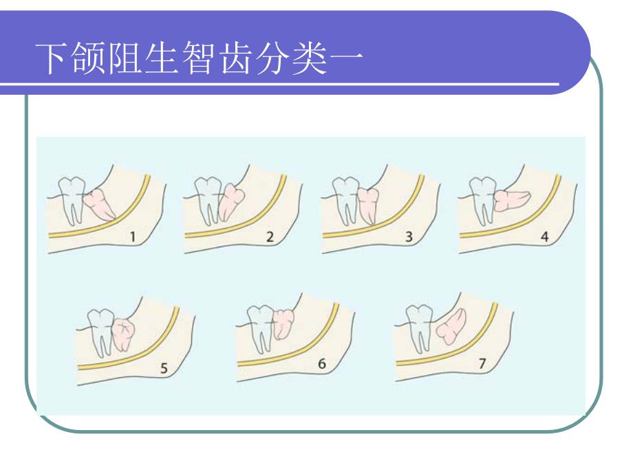 阻生牙的拔除ppt课件_第2页