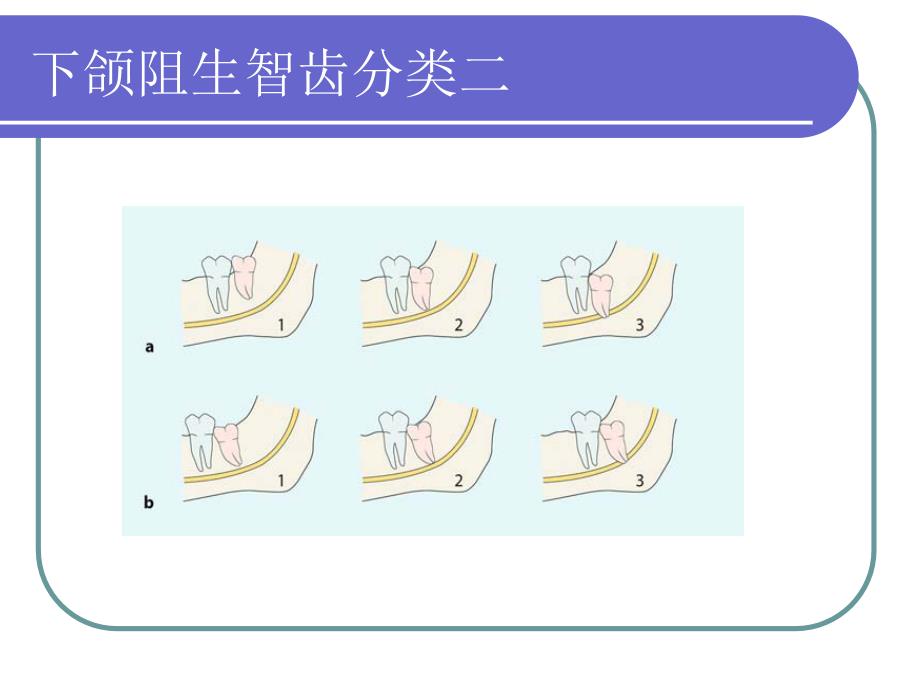 阻生牙的拔除ppt课件_第4页