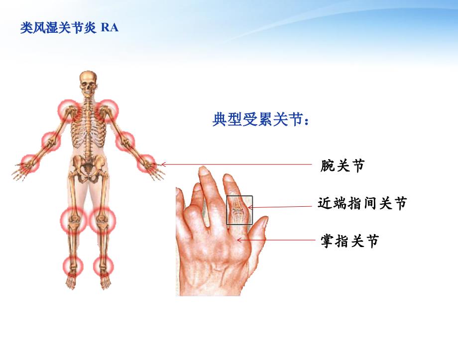 关节炎鉴别诊断说课_第4页