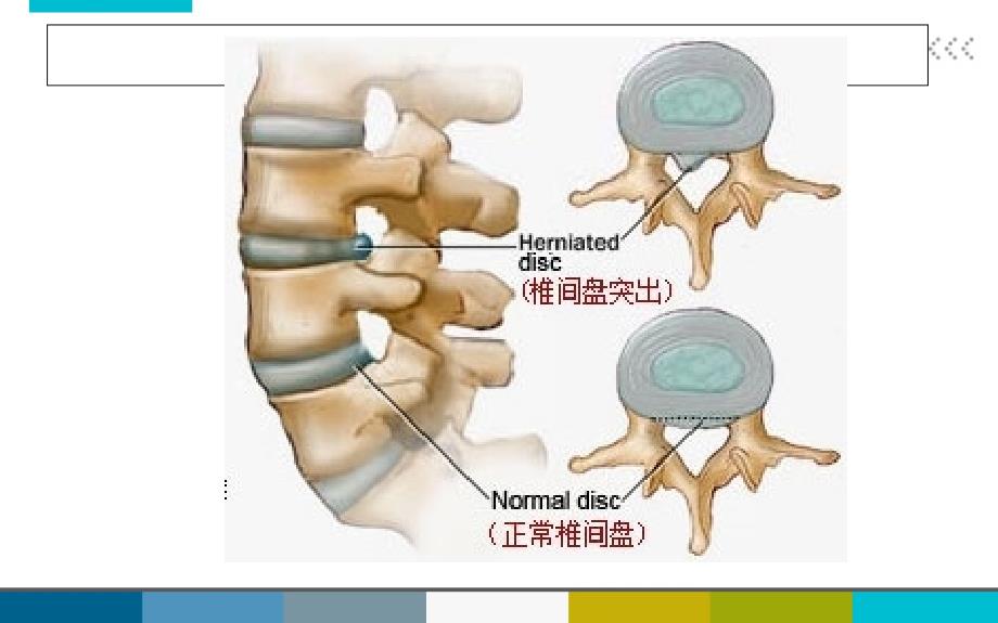 腰椎间盘术后护理教学内容_第3页