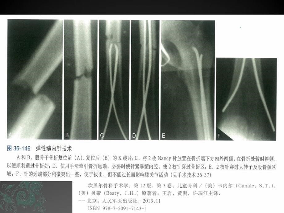 儿童长骨骨折弹性髓内钉课件_第5页