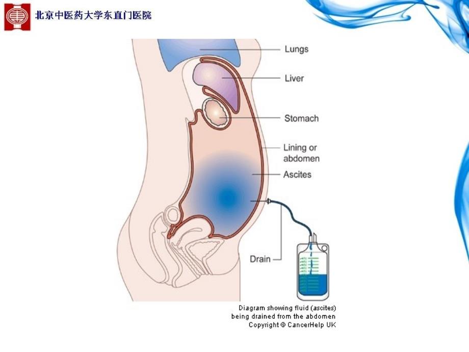 腹膜腔穿刺术.ppt_第4页