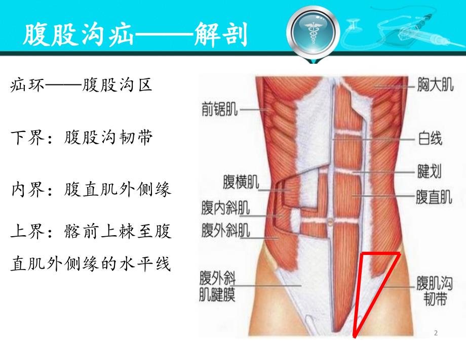 腹股沟疝课件_第2页