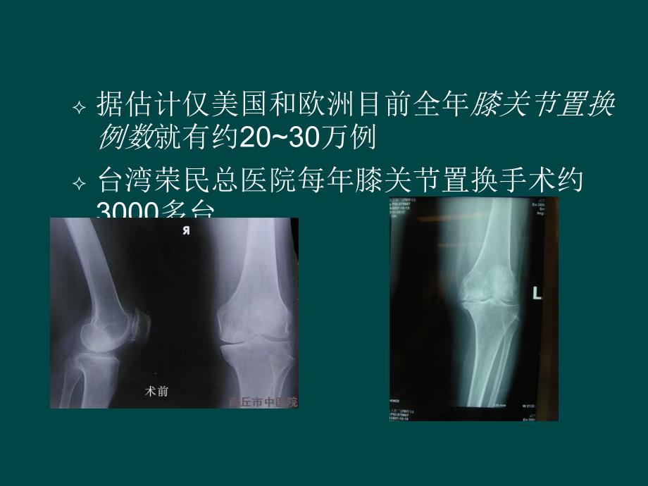 膝关节置换的手术操作和技巧ppt课件_第2页