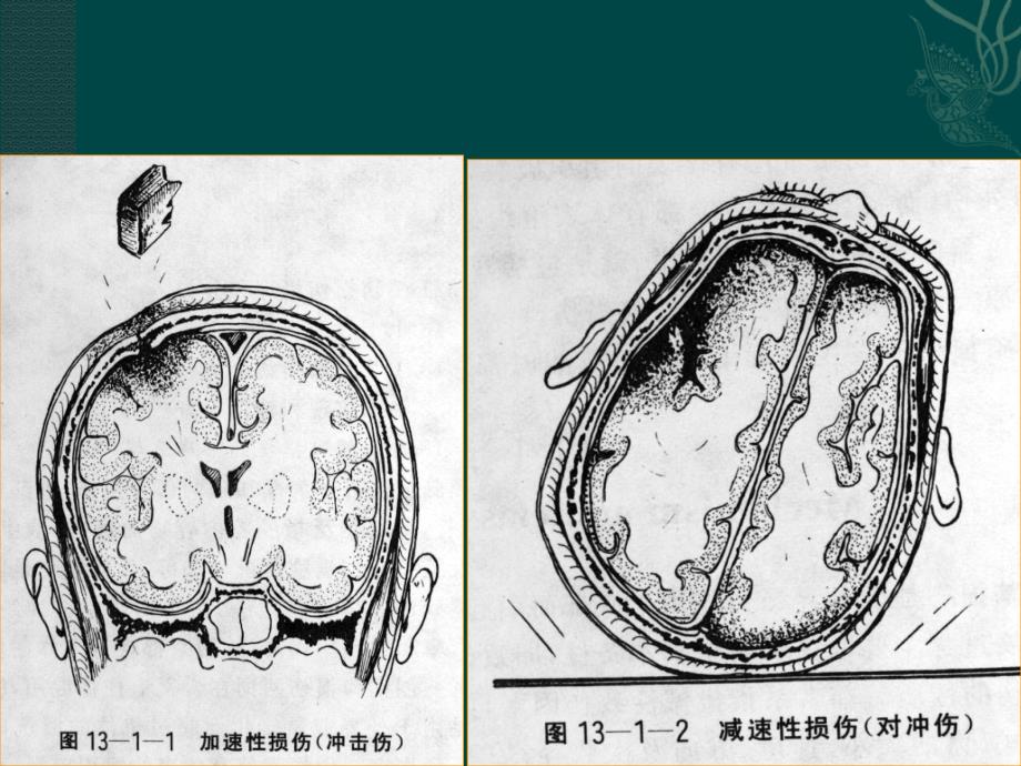 颅脑外伤的CTMR诊断_第3页