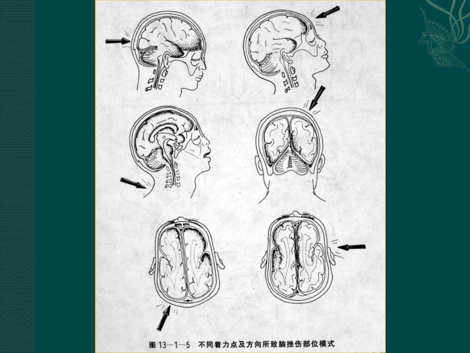 颅脑外伤的CTMR诊断_第4页