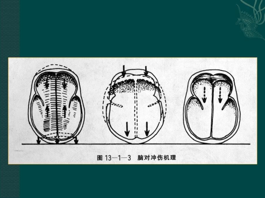 颅脑外伤的CTMR诊断_第5页