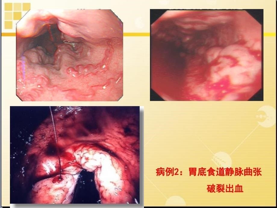 上消化道出血病人的护理图文9593682_第5页