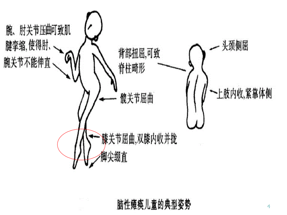 医学PPT课件常见中枢性足下垂足内翻的处理策略_第4页