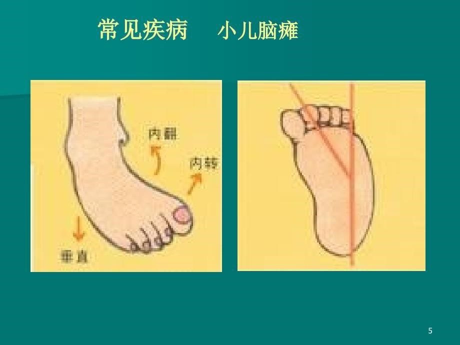 医学PPT课件常见中枢性足下垂足内翻的处理策略_第5页