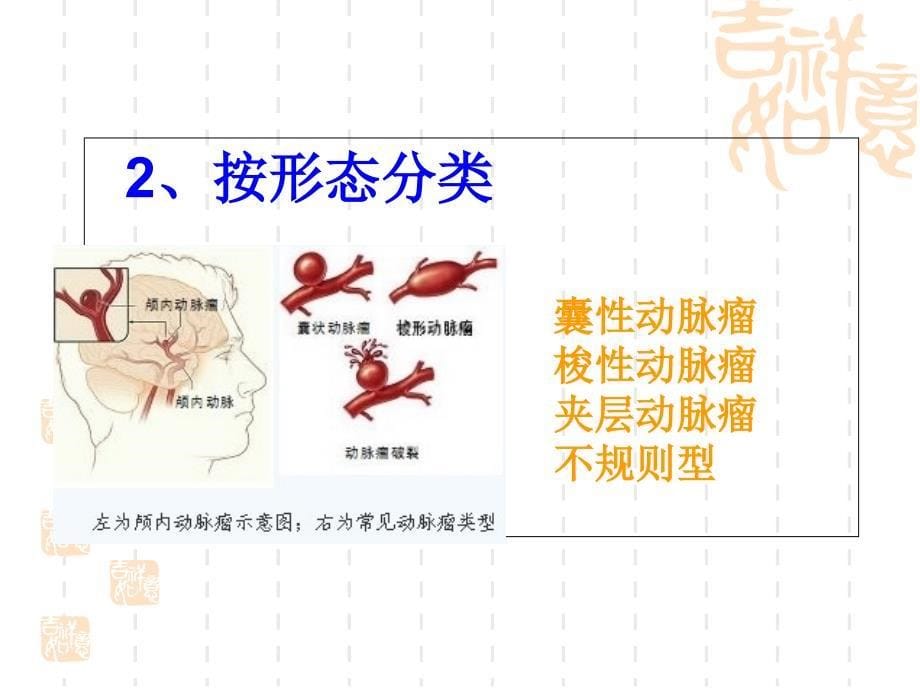 颅内动脉瘤夹闭术_第5页