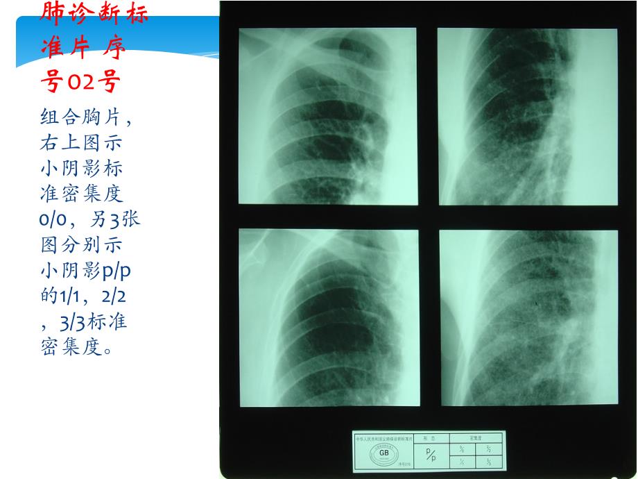 中华人民共和国尘肺标准片ppt课件_第3页