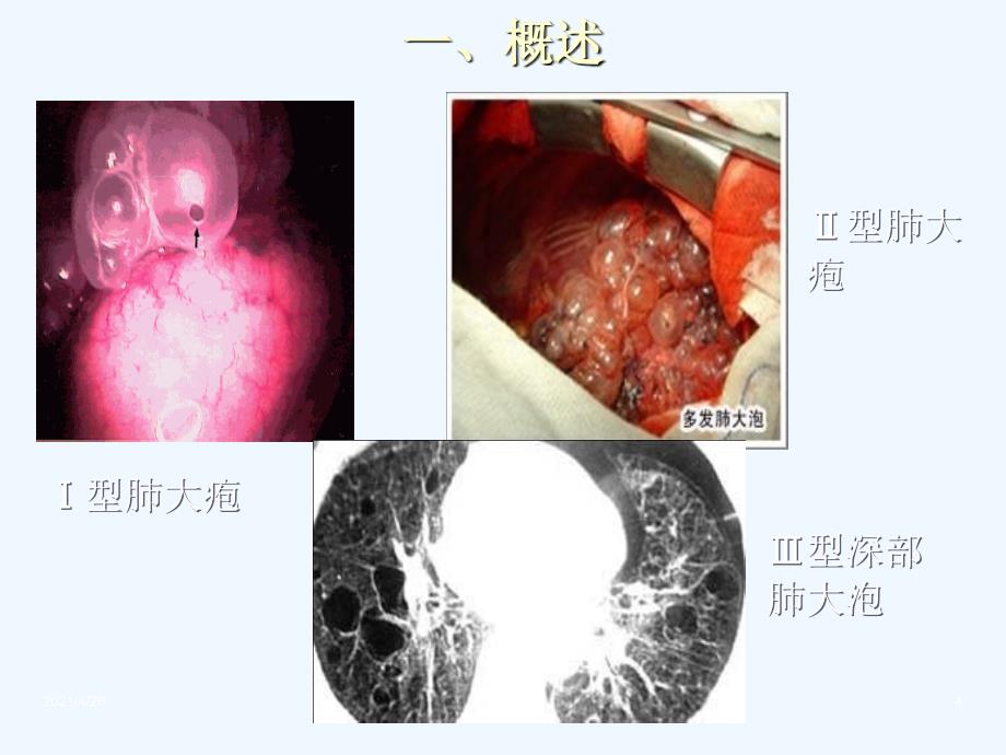 胸外科常见疾病的诊治——(二)肺大泡(疱)_第4页