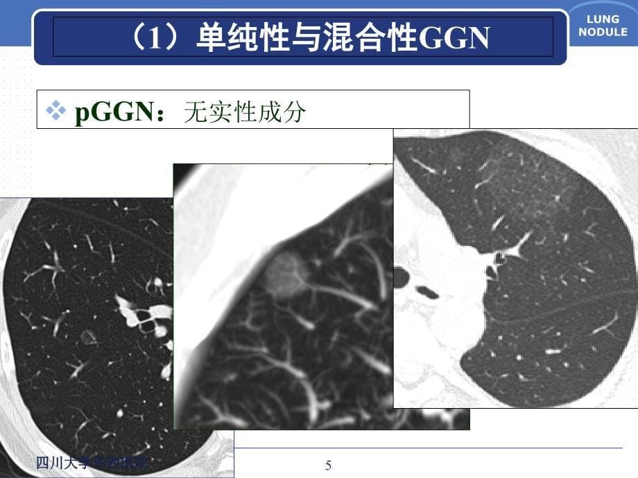 肺磨玻璃结节的CT诊断与临床处理策略_第5页