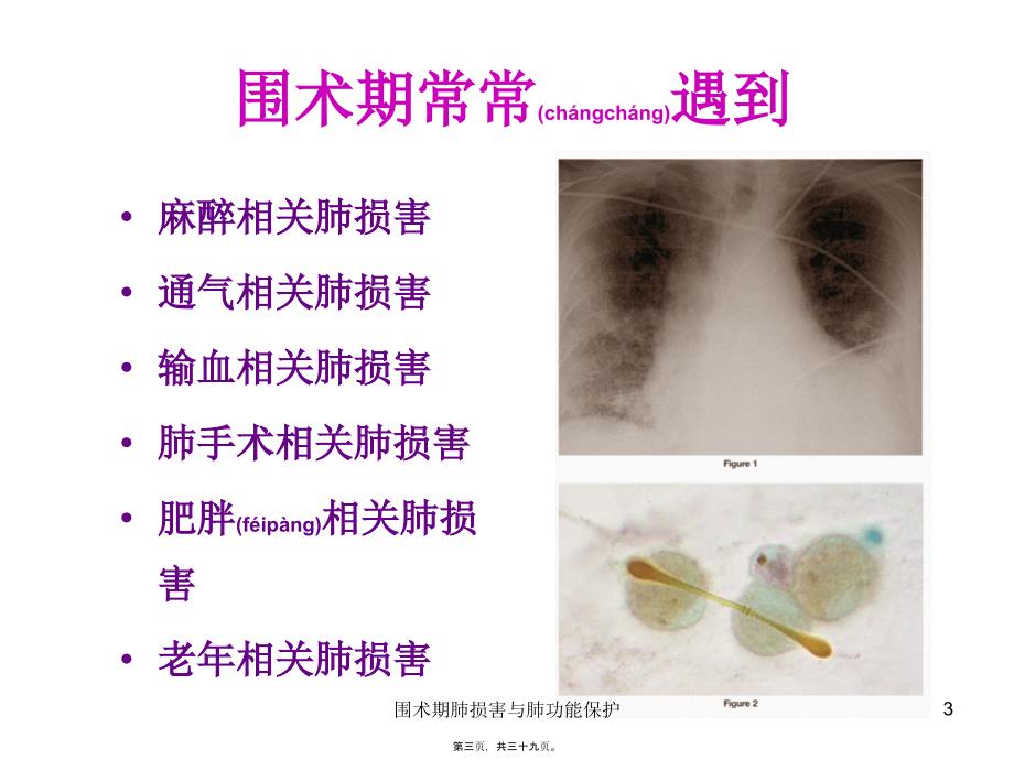 围术期肺损害与肺功能保护课件_第3页