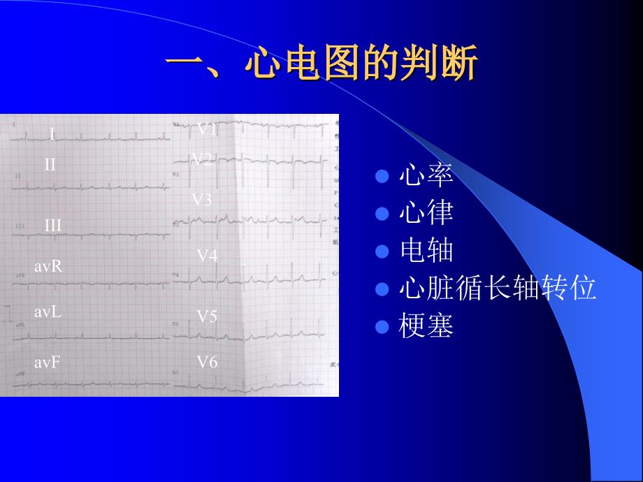 护士怎样识别心电图(上)ppt课件.ppt_第3页