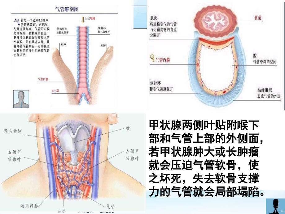 气管软化症-姜曼_第3页